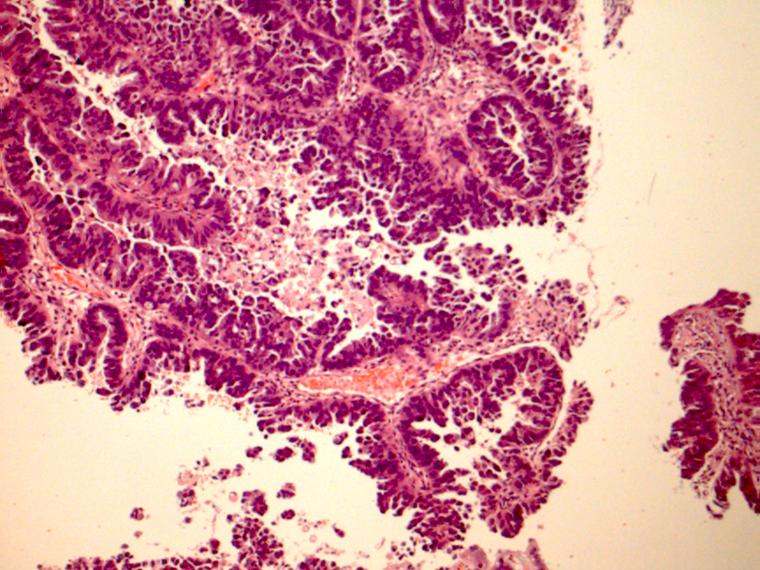 Uterine serous carcinoma